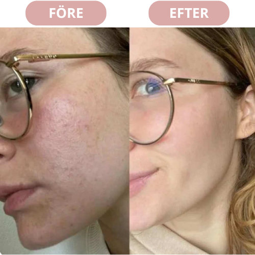 SkinLift+